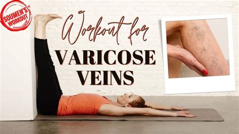 What Is Varicose Veins Get Rid Of Varicose Veins Best Exercises For