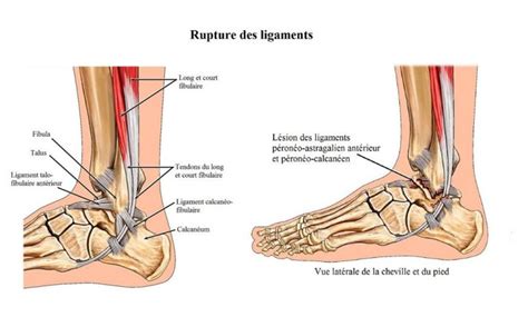 Traitement entorse cheville Prise en charge médicale complications