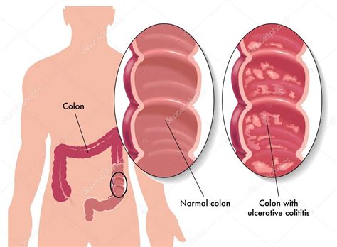 Ulcerative Colitis Stock Vector Rob