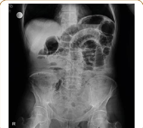 Air Fluid Levels In Abdominal X Ray Graphy Download Scientific Diagram