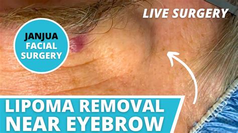 Huge Lipoma Removal Near Eyebrow Live Surgery Dr Tanveer Janjua