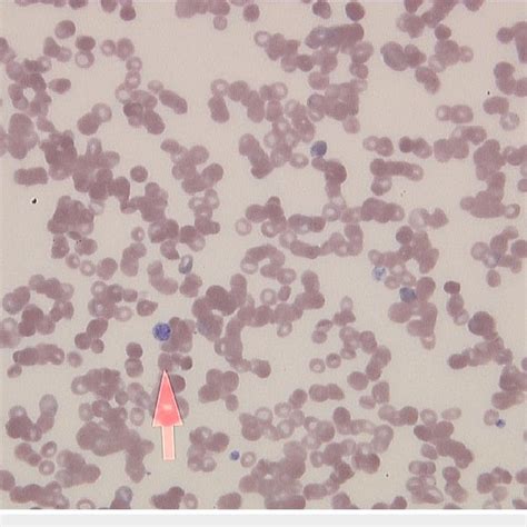 Peripheral Blood Smear The Peripheral Blood Smear Shows Giant