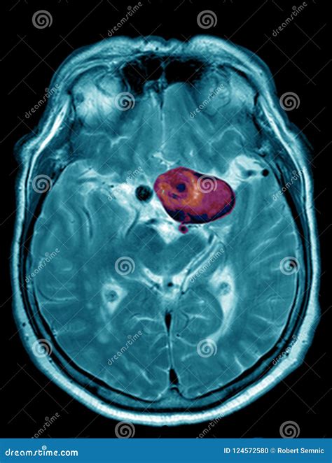 Cerebral Aneurysm Illustration Mri Stock Photo Image Of Imaging