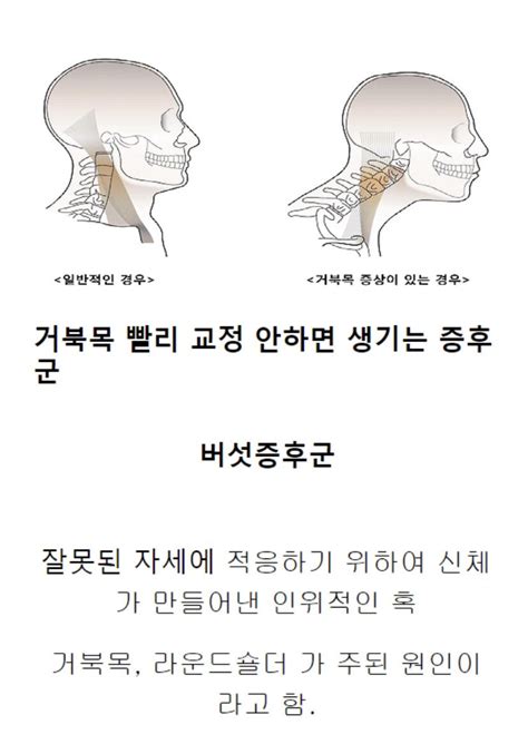 거북목 증후군 유머움짤이슈 에펨코리아