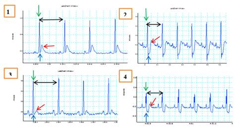 Shows ECG Recording Of Lead II Before And After ISO Injection In Lean