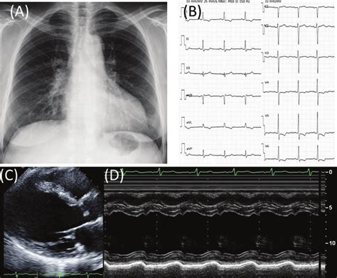 A Chest X Ray An Electrocardiogram And A Transthoracic Echocardiogram