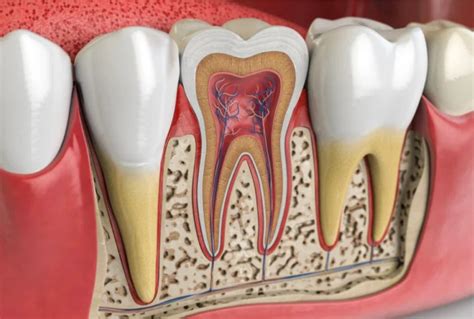 Qué es la necrosis pulpar Causas síntomas y tratamiento