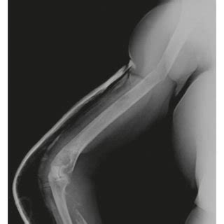 Preoperative Radiographs Demonstrating Simultaneous Lytic Lesions And