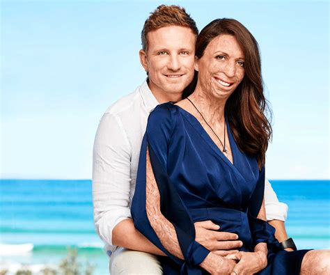Inspirational Burns Victim Turia Pitt Recovering From Reconstructive