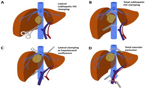 Cancers Free Full Text Vascular Involvements In Cholangiocarcinoma Tips And Tricks