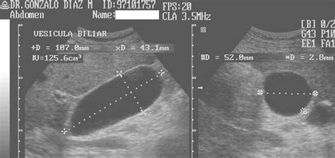 Ultrasound Image Gallbladder Hydrops