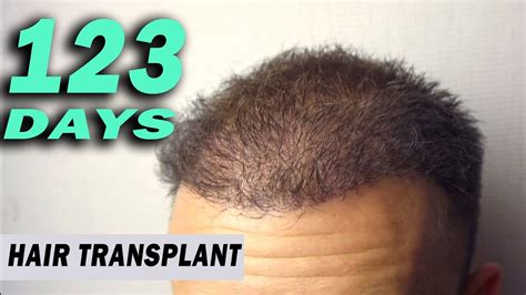 Fue Hair Transplant Day 123 Post Op Istanbul Turkey Growth Stage