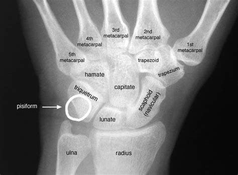 an x - ray shows the bones of the hand and wrist, with labeled carpulations