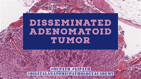 Disseminated Adenomatoid Tumor Mimicking Signet Ring Carcinoma Youtube