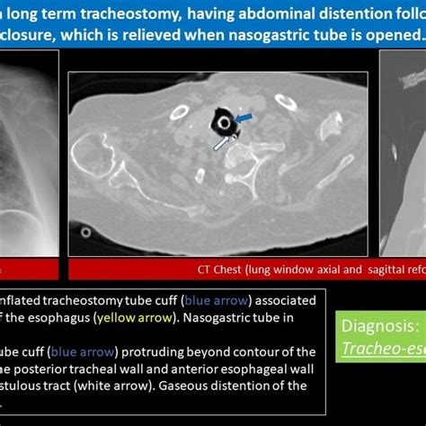 Iatrogenic Aortogastric Fistula References Clinical Imaging Hamad