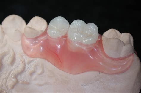 Valplast Prothese Mt Dental Zahntechnik Gmbh