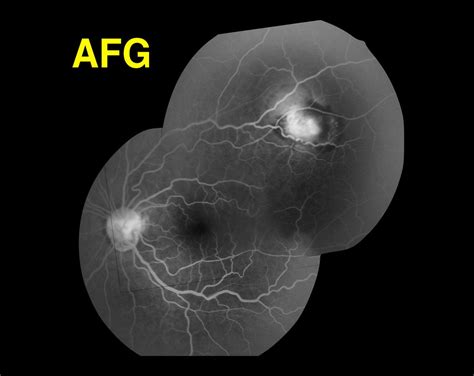 Angiograf A Retinal Somos Retina Y M Cula Consultores