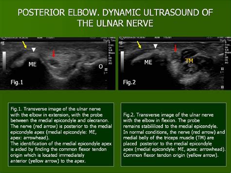 Figure From Ultrasound Of The Elbow What The Radiologist Should