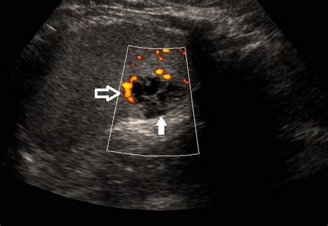 Figure Ultrasound Of The Spleen In Statpearls Ncbi Bookshelf