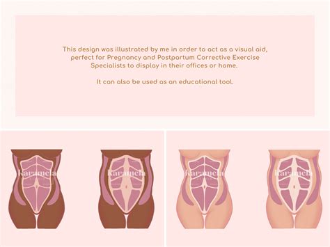 Diastasis Recti Diagram Abdominal Muscles Separation After Etsy