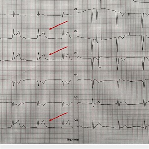 EKG After A Few Days Showing ST Segment Elevation In The Inferior Leads