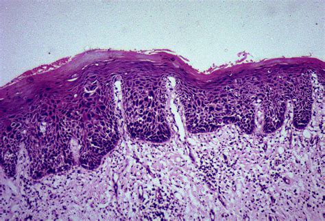 Keratosis With Severe Epithelial Dysplasia Hematoxylin And Eosin Stain Download Scientific