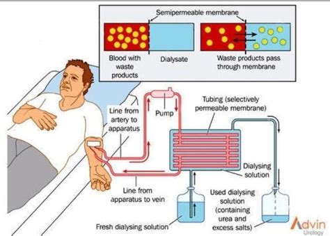 What Is Haemodialysis Explain It With A Neat Labelled Diagram