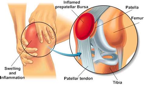 Bursitis of the knee: diagnosis and therapy - Priv.-Doz. DDr. Christian ...