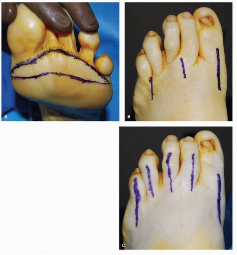 Pan Metatarsal Head Resection | Musculoskeletal Key