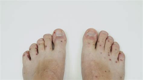 Human legs with dermatitis, allergy rash. Close up of male's foot and ...