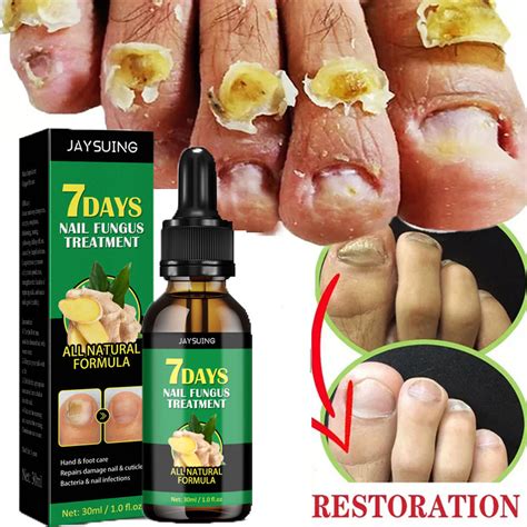 Days Ginger Nail Fungal Treatment Serum Anti Infection Remove Hand