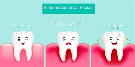 Gingivitis Causas Y Tratamiento En Lima Per Soluci N Dental