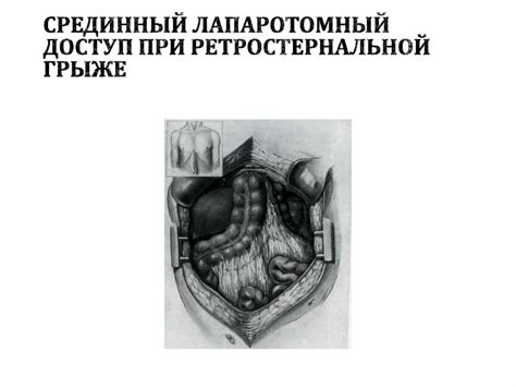 Диафрагмальные грыжи - презентация онлайн