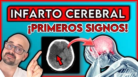 ESTOS son los PRIMEROS SÍNTOMAS de INFARTO CEREBRAL No IGNORES