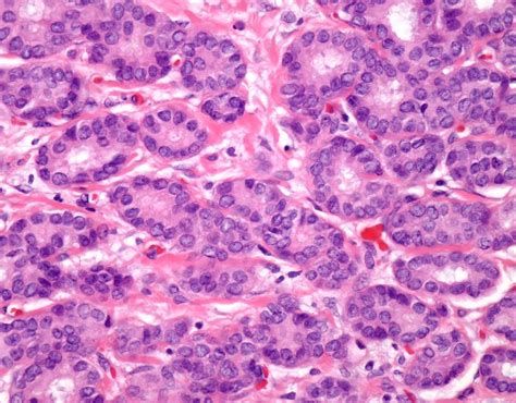 Invasive Ductal Carcinoma Stages