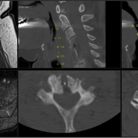 Imaging Of Case 2 With A Cervical Abscess Extending From C2 To C7 Left