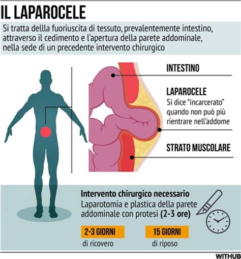 Che cos è il laparocele di cui soffre il Papa