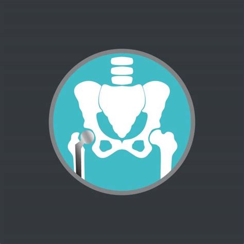 70 Hip Replacement Implant Stock Illustrations Royalty Free Vector