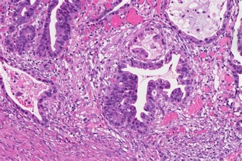 Intramucosal Adenocarcinoma Of The Stomach Atlas Of Pathology