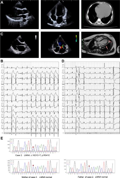 The Lmna P R C Mutation Causes Dilated Cardiomyopathy In Human And