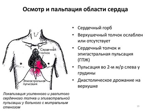 Пальпация перкуссия аускультация при стенокардии - фото презентация