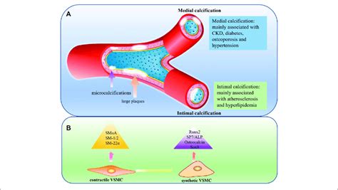 A Medial Calcification And Intimal Calcification In Medial