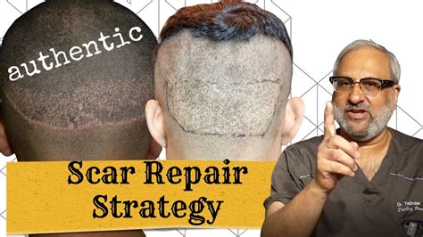 Hair Transplant Scar Repair What To Do If Your Scar Doesnt Look Good Youtube