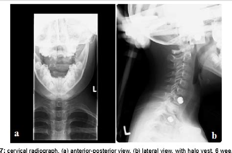 Figure From Non Traumatic Atlanto Axial Rotatory Subluxation Grisels