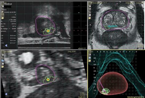 Biopsia Prostatica Fusion Dott Angelo Cafarelli