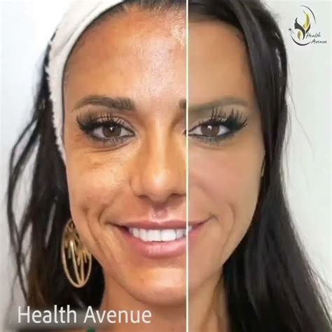 Skin Rejuvenation Youtube