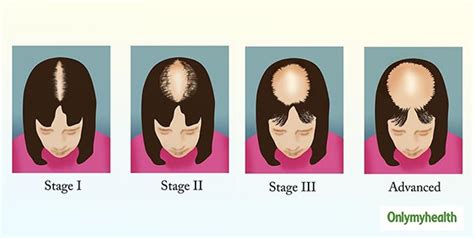 Female Pattern Hair Loss: Symptoms, Stages And Treatment | OnlyMyHealth