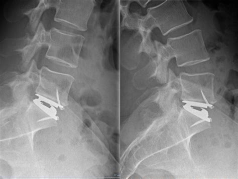 Lumbar Disc Arthroplasty – Sealand Spine Community