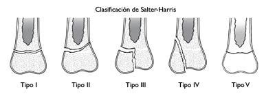 apretón Organo escaramuza cartilago de crecimiento en la rodilla