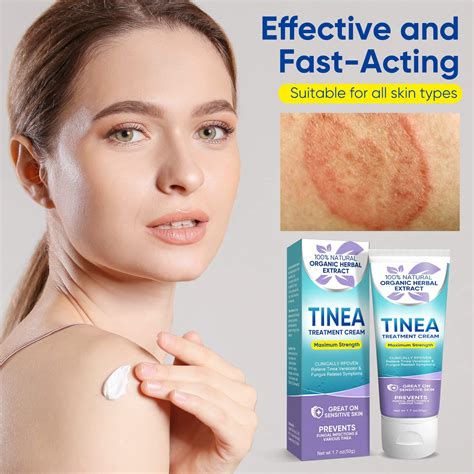 Over The Counter Antifungal Cream For Tinea Versicolor At Donald Mccann